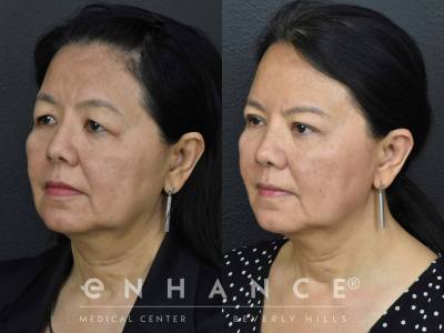 Before and afters - 201