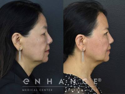 Before and afters - 200