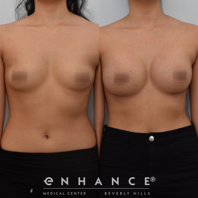 breast augmentation