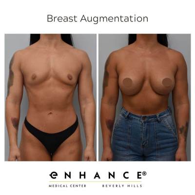 breast augmentation