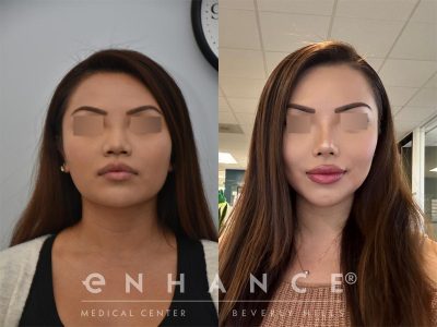 Chin Augmentation