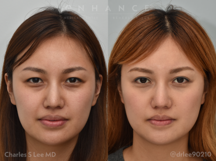 Eyelid before and after photos