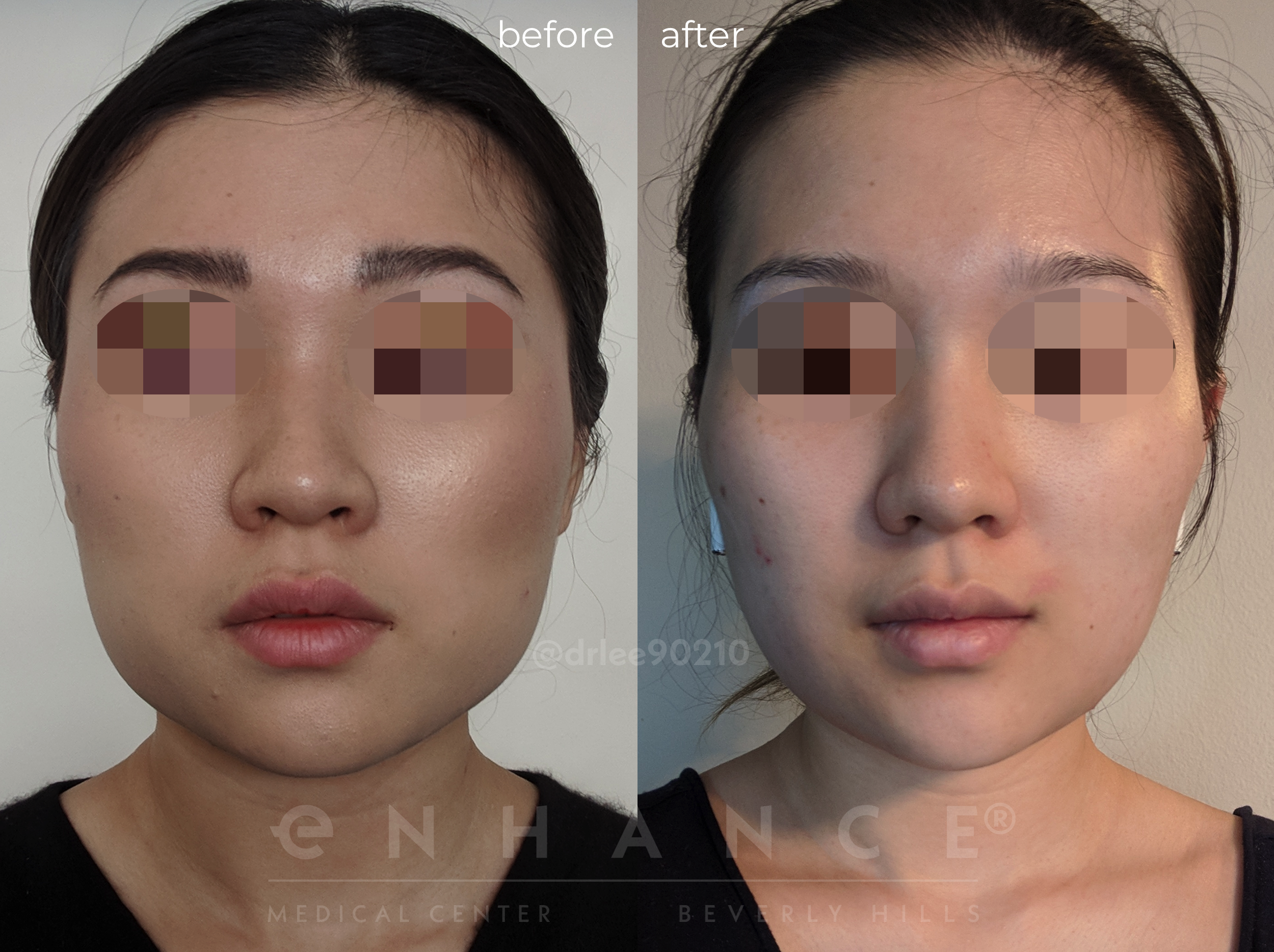 Jaw reduction photos