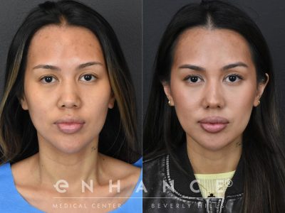 Before and afters - 175