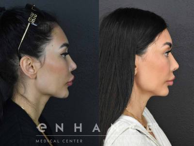 Before and afters - 187