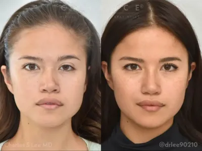 rhinoplasty-100