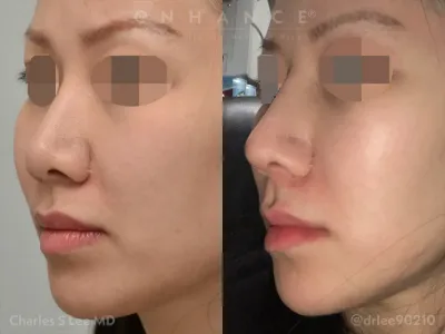 rhinoplasty-102