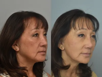 rhinoplasty-104