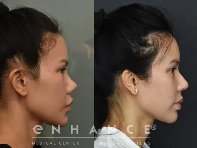 rhinoplasty-16