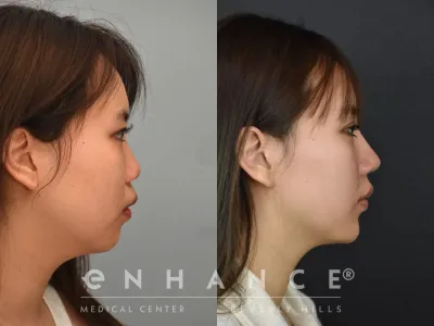 rhinoplasty-23