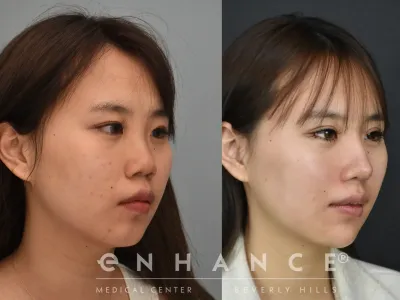 rhinoplasty-24