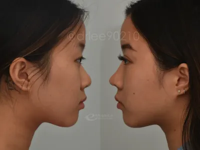 rhinoplasty-28