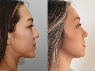 rhinoplasty-45