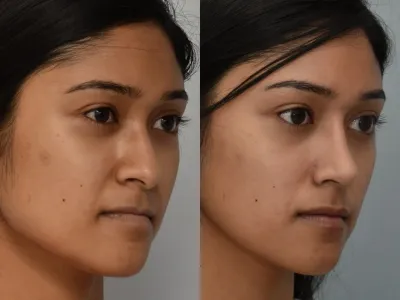 rhinoplasty-49