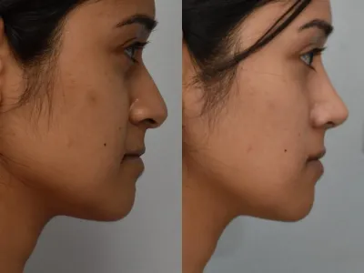 rhinoplasty-50