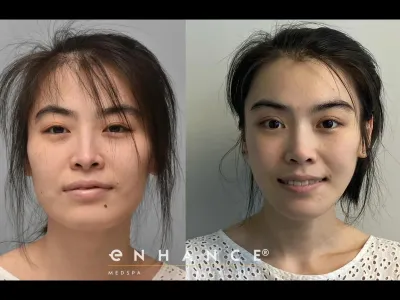 rhinoplasty-64