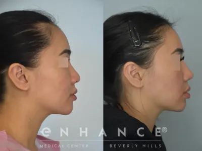 rhinoplasty-68