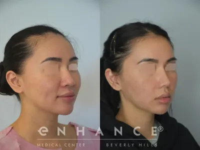 rhinoplasty-69