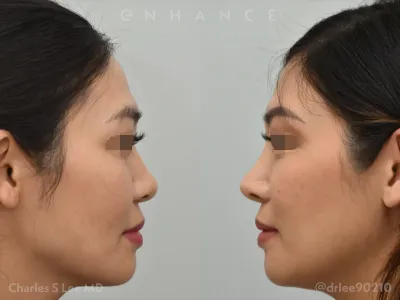 rhinoplasty-83