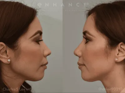 rhinoplasty-85