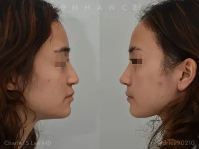 rhinoplasty-88