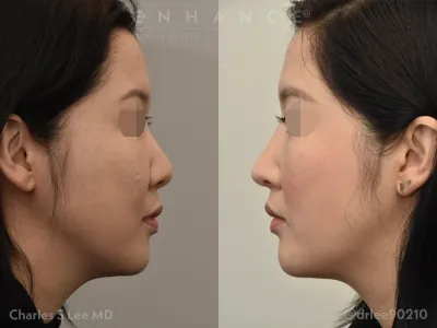 rhinoplasty-99