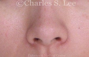 Nostril Narrowing Patient After