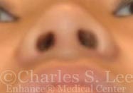 Nostril Narrowing Patient After 2 6 Months