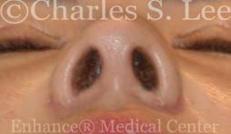 Nostril Narrowing Patient After 4