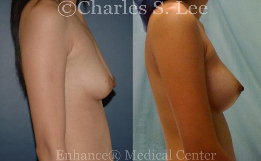 Breast Augmentation Patient Right Side View