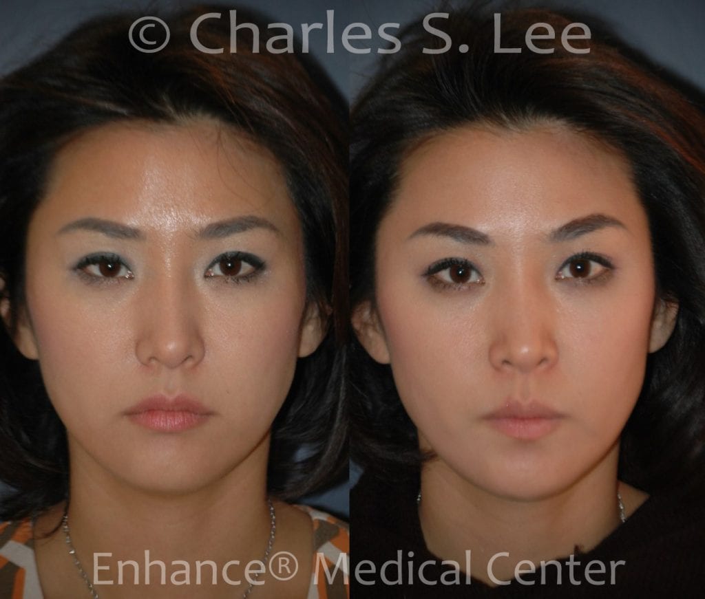 Non surgical browlift, midfacelift, lip-corner lift actual patient