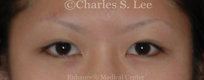 Asian double eyelid plastic surgery patient before 2