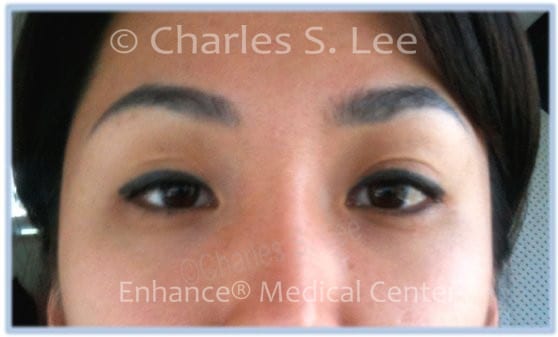 Upper Eyelid Before Surgery