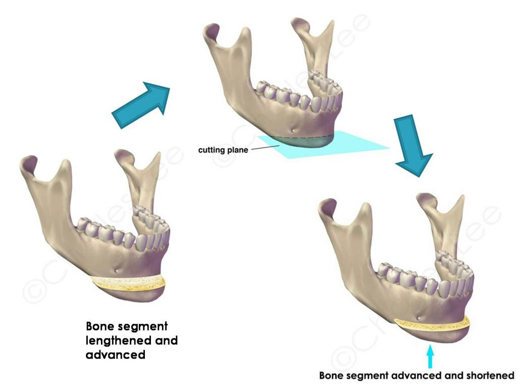 Before and After Chin Augmentation Diagram