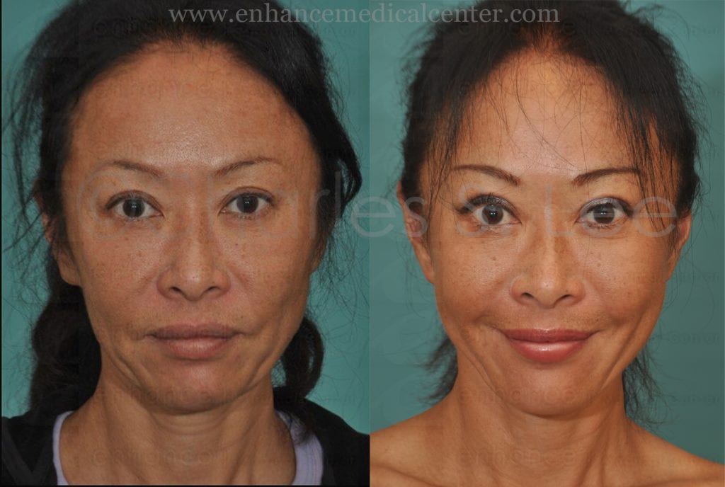 Face and Neck Lift with Upper and Lower Eyelid Surgery Actual Patient 1