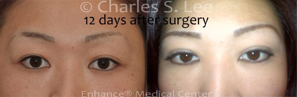 Incision Eyelid Surgery 12 days post operative