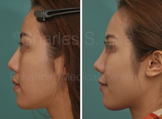 Revision nose surgery actual patient 2