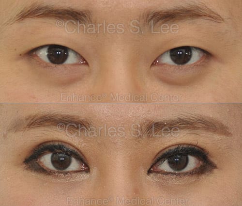 Asian eyelid surgery with removal of inner skin (inner epi) to show more eye and give a natural crease.