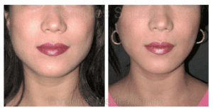 Jaw Reduction before and after