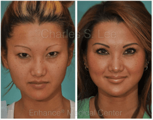 Asian Eyelid Surgery Before and After Photos