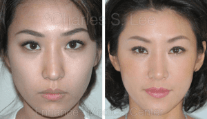 Rhinoplasty actual patient results