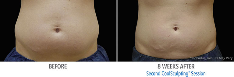 Coolsculpting Before After