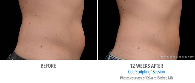 CoolSculpting Before After Photos in Beverly Hills