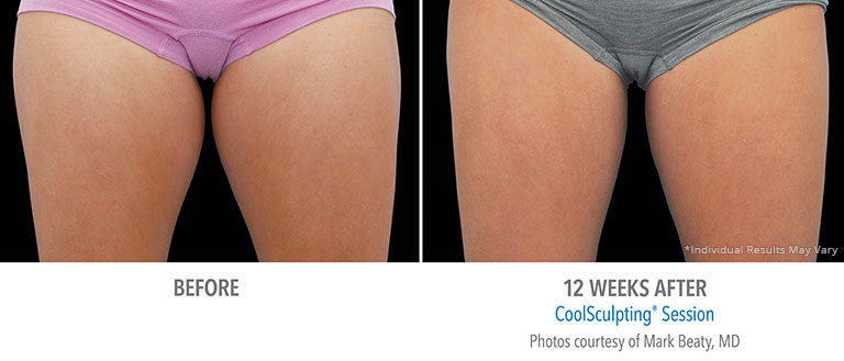 Thigh Coosculpting Results