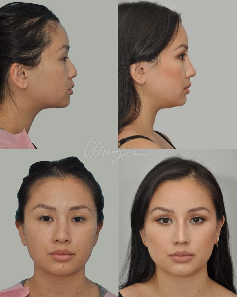 Organic Asian Rhinoplasty Actual Patient