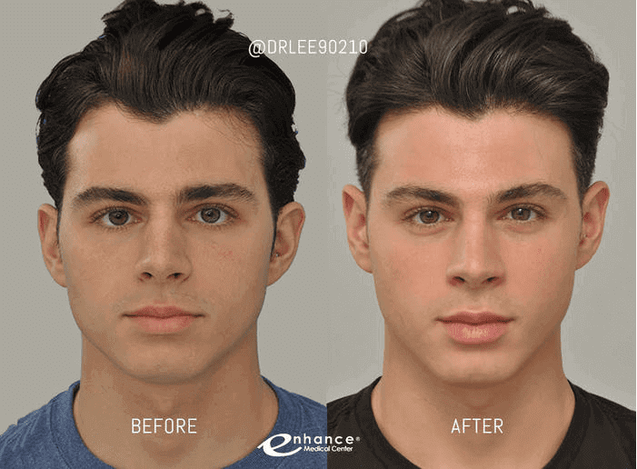 Male Cheek Reduction Before and After