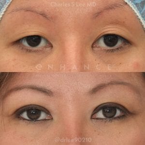 This patient had weakness of both of her eyelids, worse on her right. Both eyelid muscles were tightened (ptosis repair) and a crease placed. Note that the eyelashes no longer point downward and the vertical opening is greater than preoperatively.