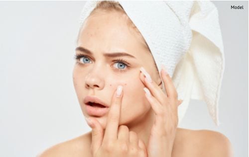 woman-with-a-white-towel-on-her-head-squeezes-acne-on-her-face-img-blog-compressor